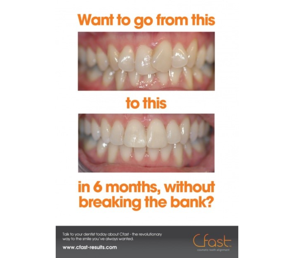 Before and after images showing teeth straightening results using Cfast clear aligners.