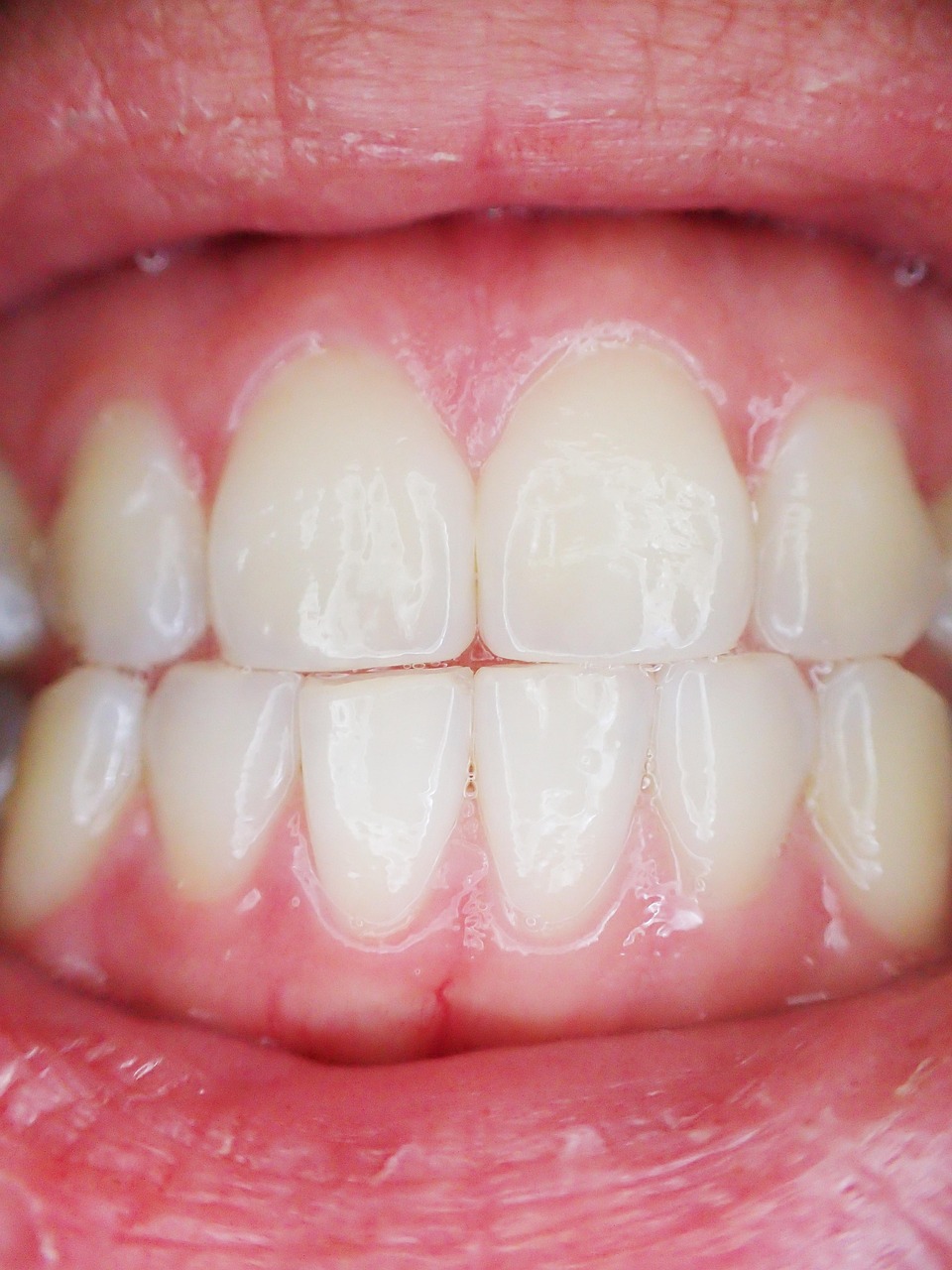 Close-up of straight teeth with Invisalign