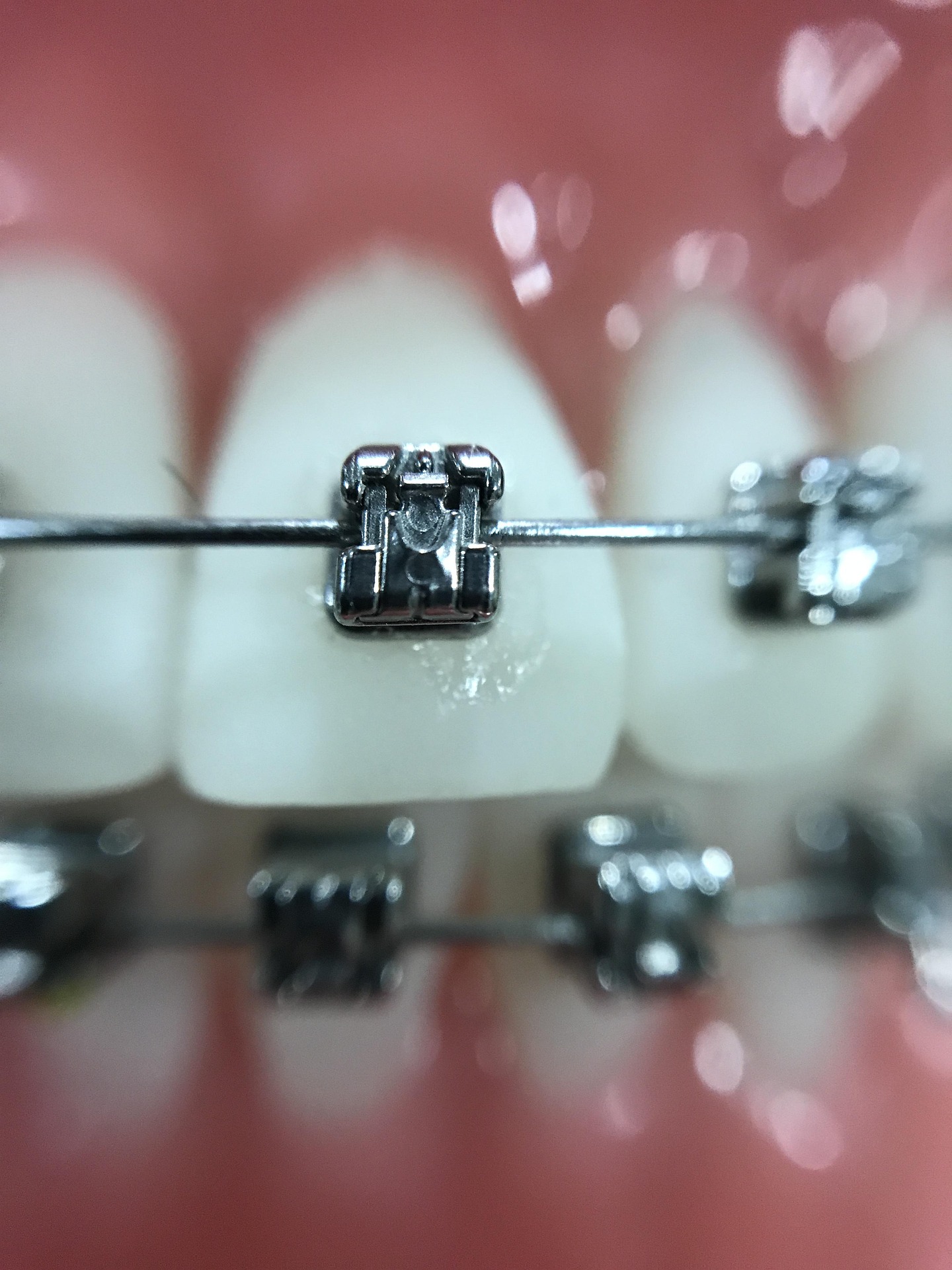 Dentist adjusting dental braces