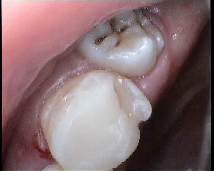 Wisdom teeth removal Adelaide for impacted wisdom tooth extraction Impacted wisdom tooth beside molars, illustrating Adelaide wisdom tooth removal and wisdom teeth extraction.