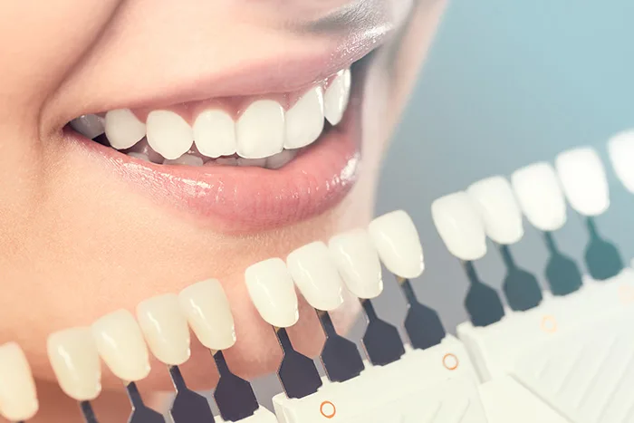 Dental implants Adelaide: a cosmetic dentist compares tooth shades to colour-match implants and veneers with the patient's natural teeth for a seamless, natural-looking result.