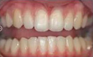 Perfectly aligned teeth after completing teeth straightening treatment
