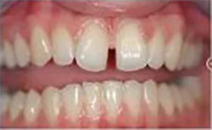 Tooth gap visible before teeth straightening treatment